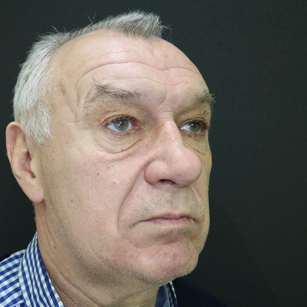 Блефаропластика — до