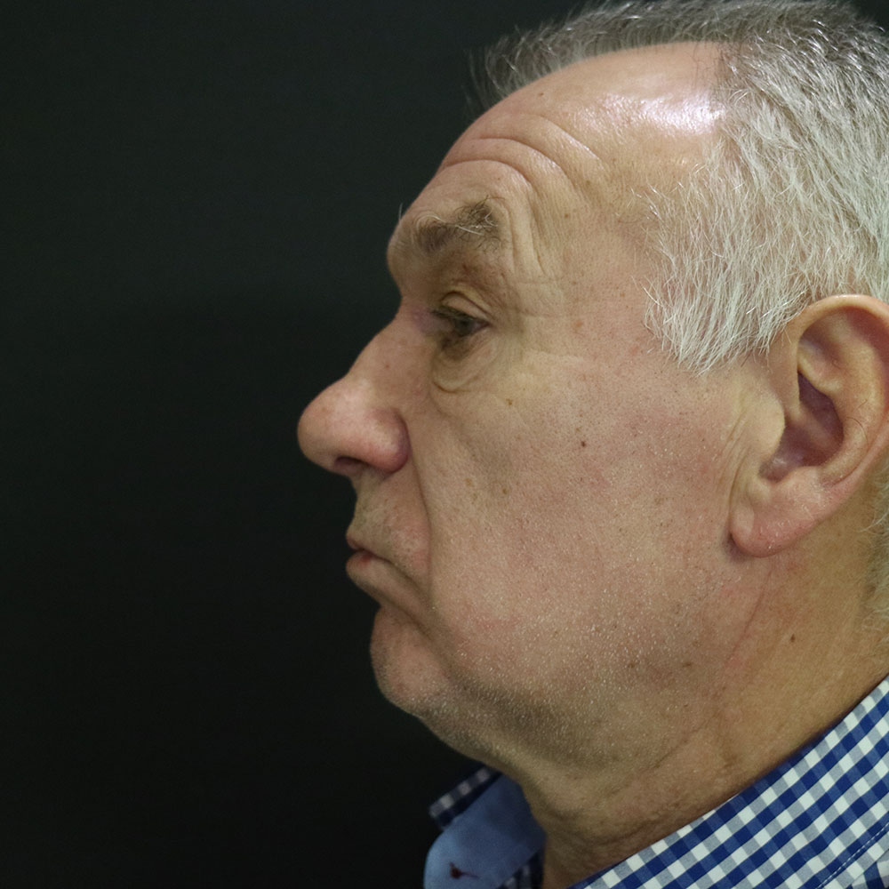 Блефаропластика — до